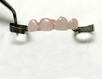 Pediatric Dental Partial appliance